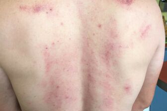 Gua Sha - regenerační čínská masáž - 3