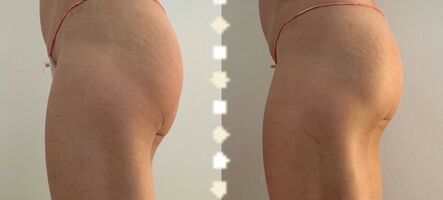 Lymfomodeling - Brazilská lymfodrenáž