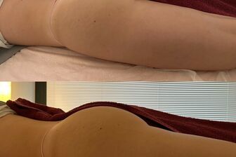 Lymfomodeling - Brazilská lymfodrenáž - 1