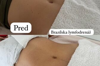Lymfomodeling - Brazilská lymfodrenáž - 2