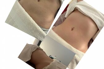 Lymfomodeling - Brazilská lymfodrenáž - 3