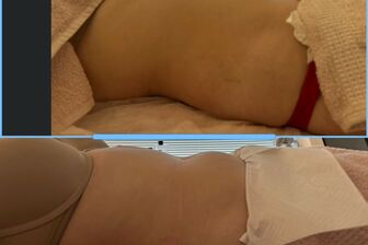 Lymfomodeling - Brazilská lymfodrenáž - 4