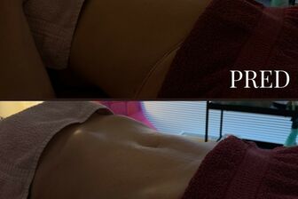 Lymfomodeling - Brazilská lymfodrenáž - 5